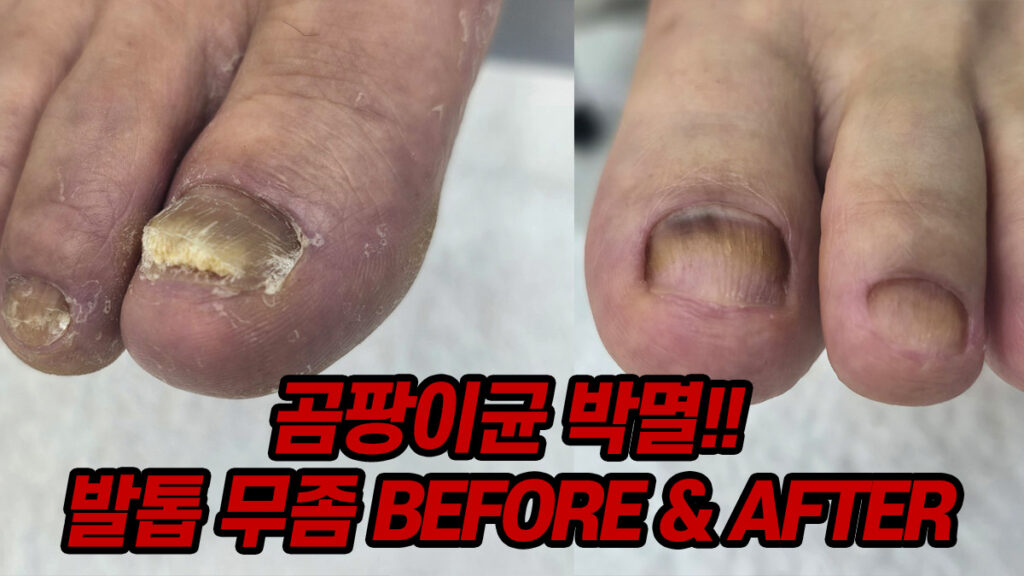 레푸스 동탄역점 발톱 무좀 관리 Before & After